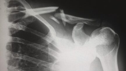 X-Ray of Broken Bones